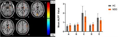 Gender differences in major depressive disorders: A resting state fMRI study